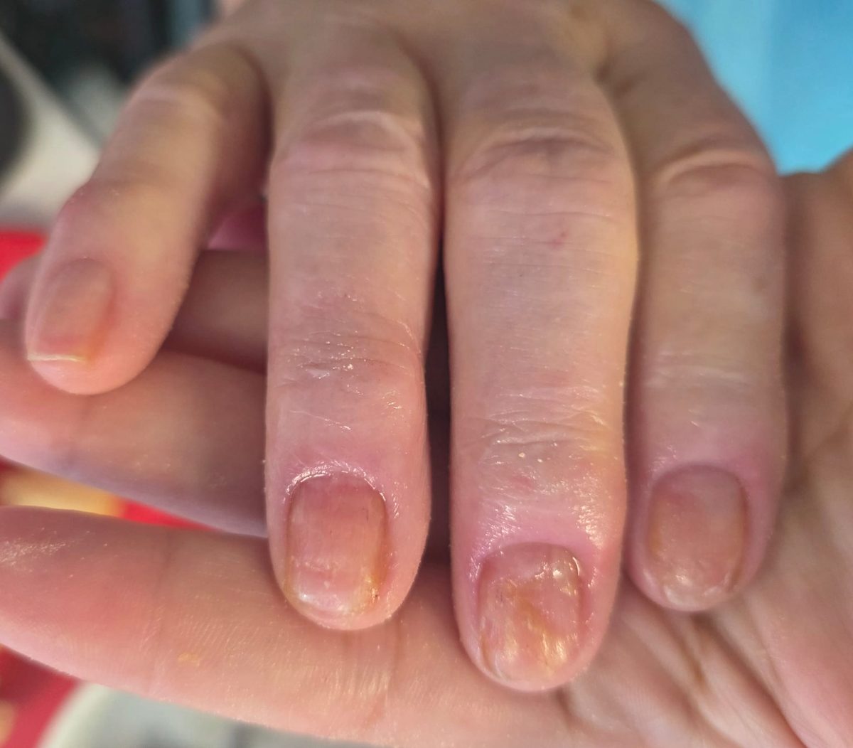 After — Onicomicose